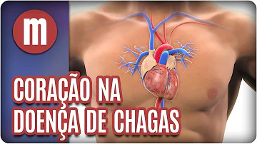 O que a doença de Chagas causa no coração?