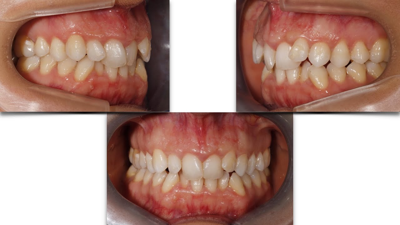 Severe crowding, severe rotations, Class II solved with aligners