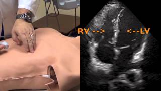 Pulmonary Embolism evaluation using Ultrasound