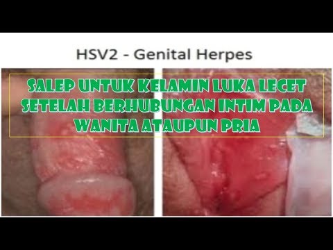 Se puede contagiar el herpes genital cuando esta inactivo