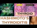 HASHIMOTO'S THYROIDITIS: Etiopathogenesis, Morphology & Complications