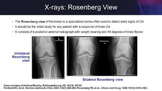 Knee Osteoarthritis: Examining the Evidence on Single-Injection Hyaluronic Acid screenshot 4