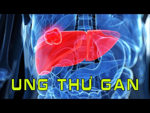 Điều trị ung thư gan, phổi bằng phương pháp tự nhiên không dùng thuốc