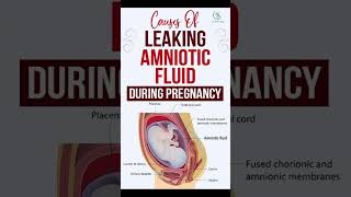 Causes Of Leaking Amniotic Fluid During Pregnancy  #pregnancy #pregnancycare   #health #wellness