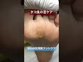 タコ魚の目ケア