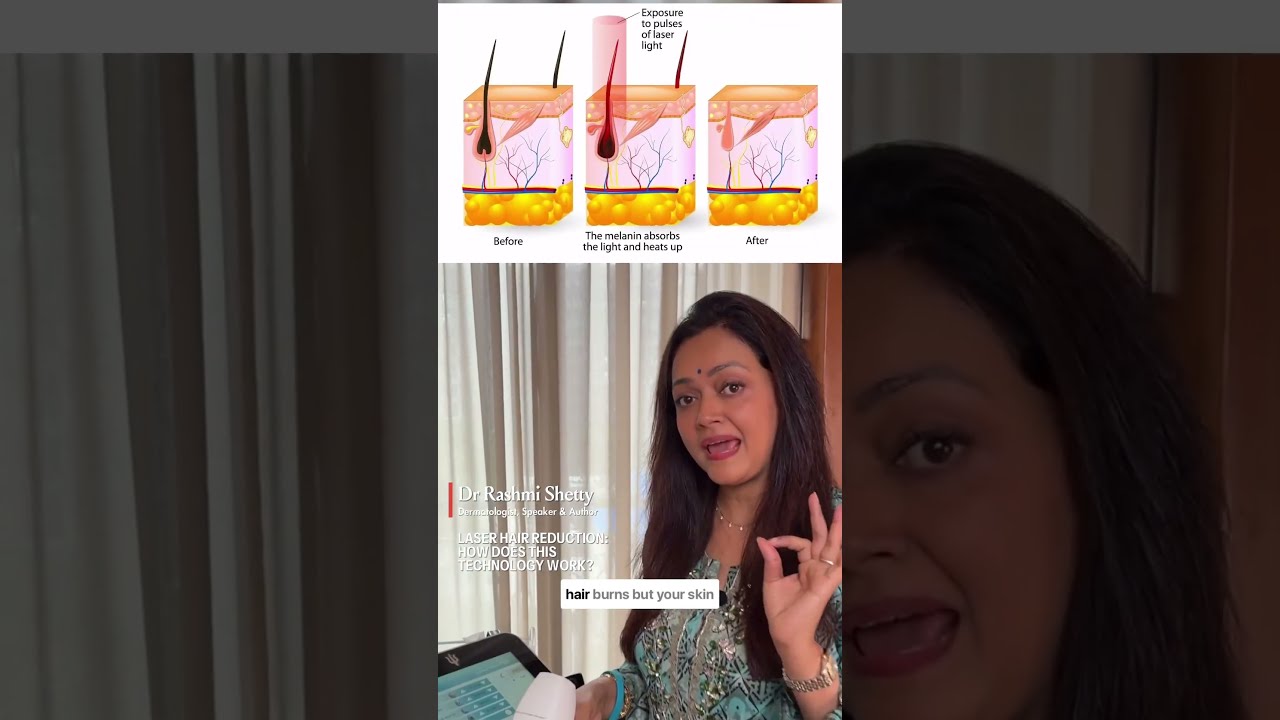 Lasers Hair Reduction How Does It Really Work By Dr Rashmi Shetty