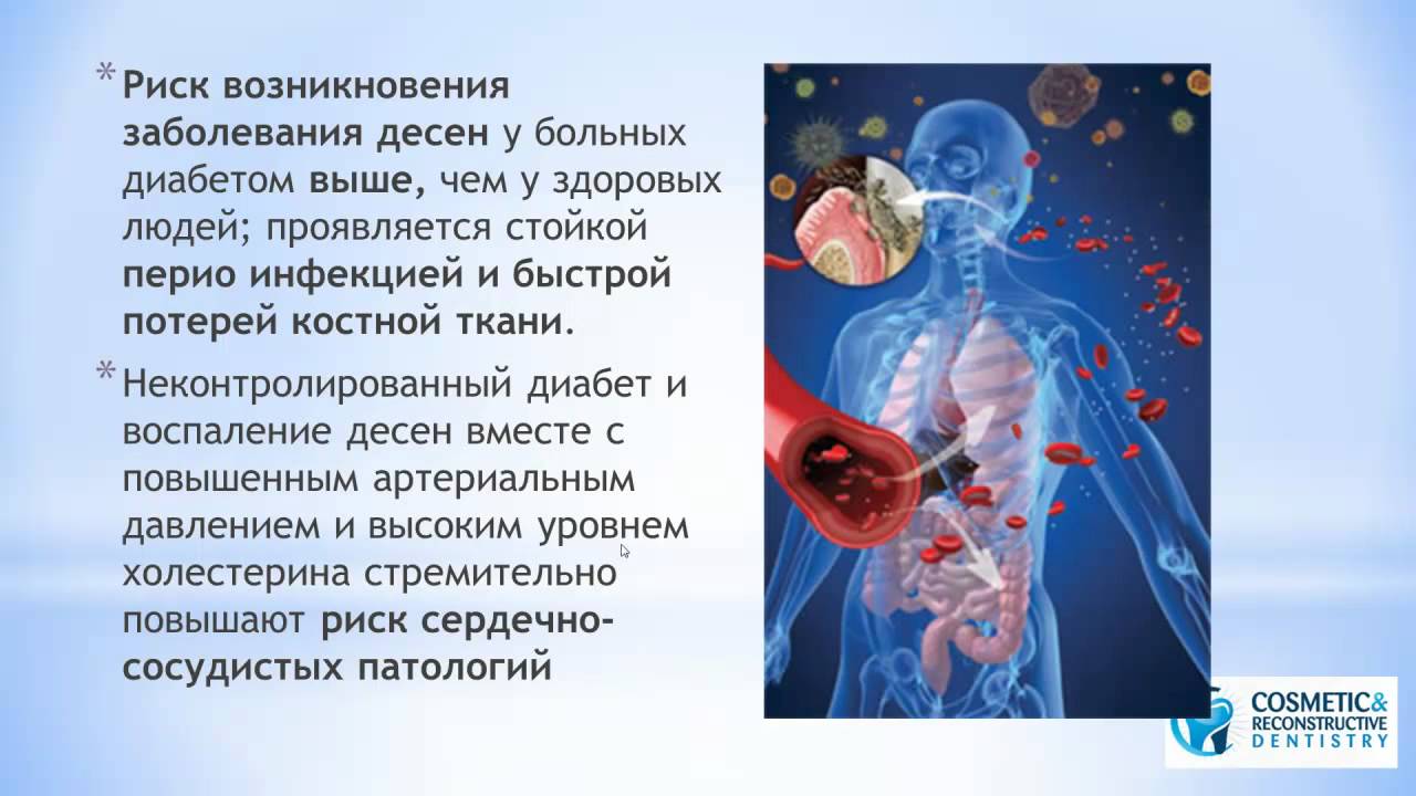 Cахарный диабет, десны и стоматологические импланты