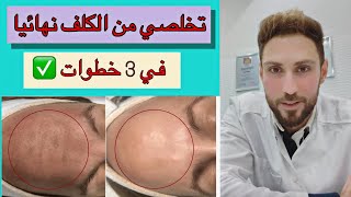 علاج الكلف من الوجه وكيفية التخلص منه نهائيا