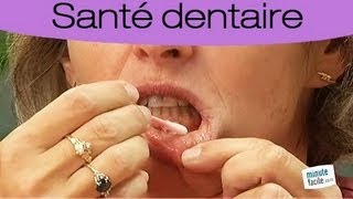 Conseils Santé Lutter Contre Les Aphtes