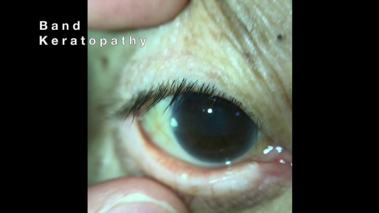 Band Keratopathy YouTube