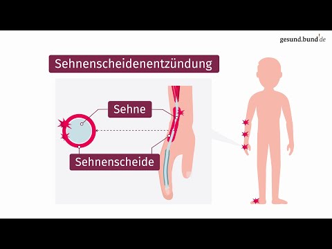 Video: Warum bekomme ich ständig eine Sehnenscheidenentzündung?