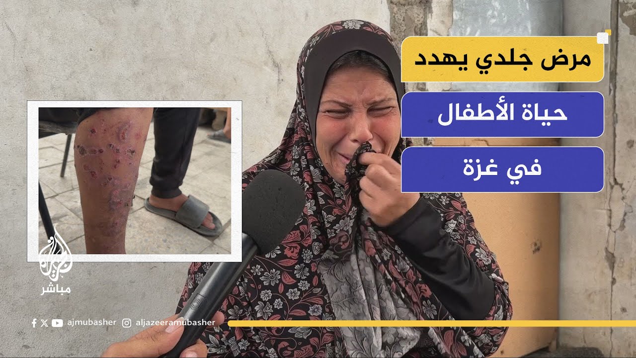 كشف معاناة النازحين في غزة.. مرض جلدي يهدد الأطفال!