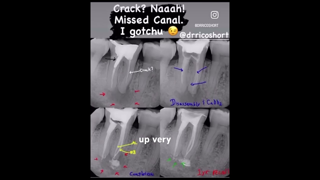 Is This Tooth Cracked? Does It Have A Vertical Root Fracture?Check Out This Case! 