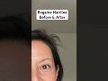 Rogaine Foam Hairline Before And After 💁🏻‍♀️ Minoxidil For Women
