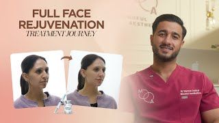 10Ml Full Face Filler Transformation Natural Results Treatment Journey