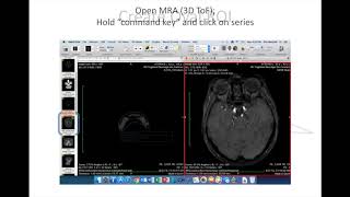 Celebrity Osirix Meshlab processing Profile