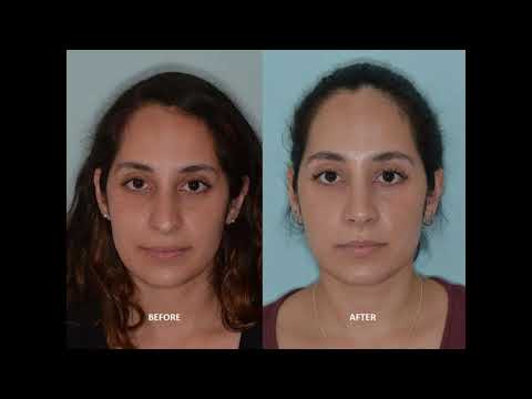 Video thumbnail: Rhinoplasty for droopy tip when smiling   I   Anthony Bared, MD, FACS   I   Miami, FL