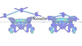 Mechanics of External Fixation for Pelvic Fractures Using Finite Element Analysis