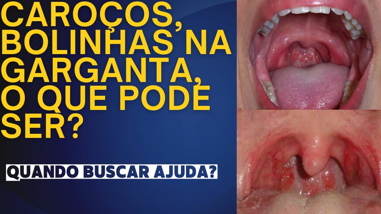 Caroços, bolinhas na garganta, o que pode ser? Quando buscar ajuda?  #caroços #garganta #faringite, image size:1280x720