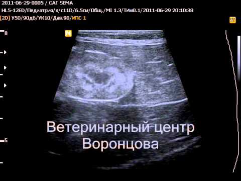 Пункционная биопсия почки