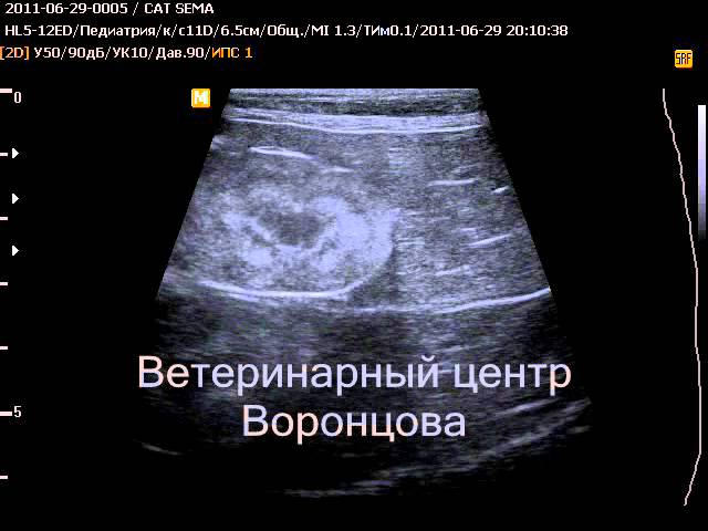 Как проводится биопсия почки?