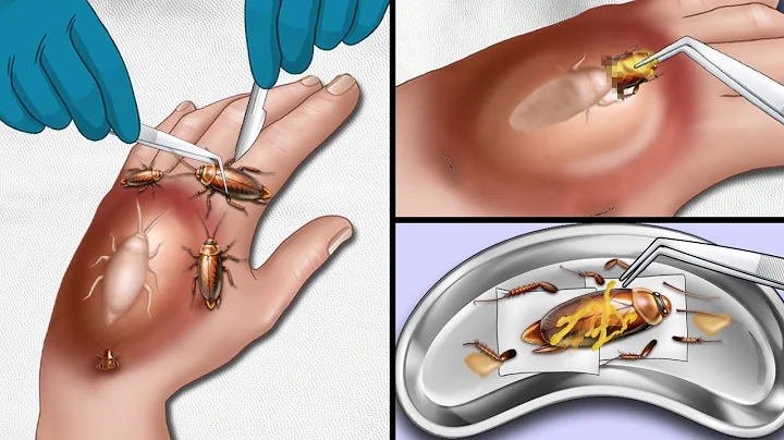 [ASMR Animation] Help Chovy get rid of cockroaches on the back of his hands | WOW Brain Satisfying