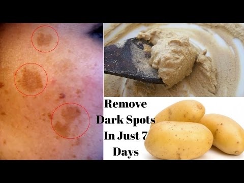 Remove Dark Spots & Acne Scars In Just  Days| % Effective Home Remedy| Potato For Spotless Skin