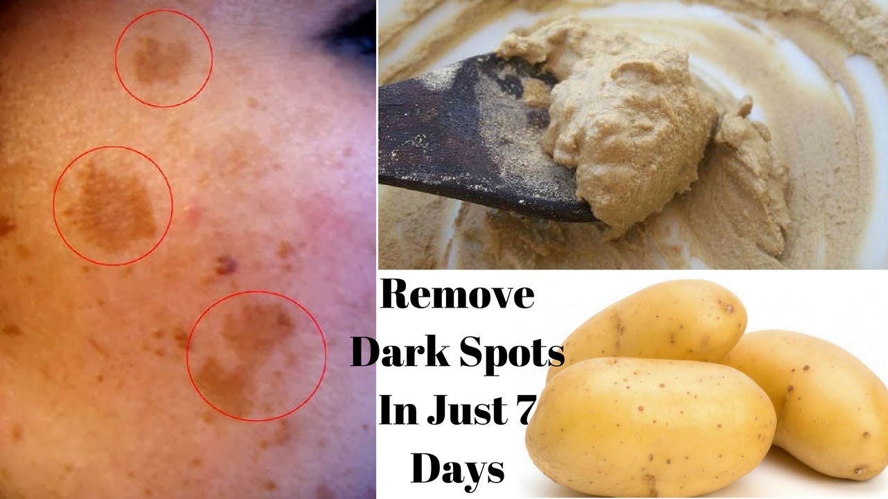 Potatoes for acne scars How to remove acne scars with potatoes picture Potatoes for acne scars How to remove acne scars with potatoes photo