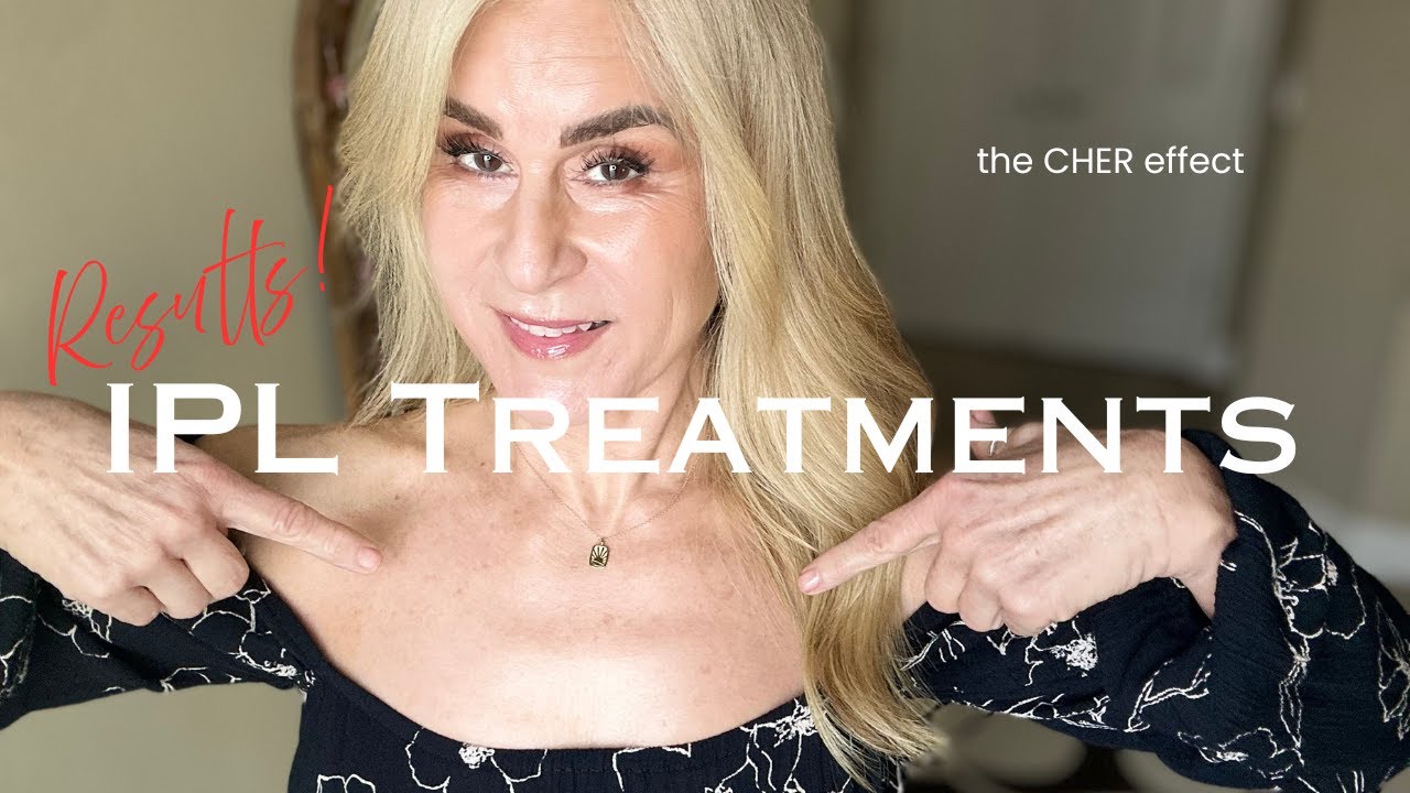 Лечение солнечных ожогов с помощью IPL: работают ли они? Мои результаты! @Drsamanthaellis