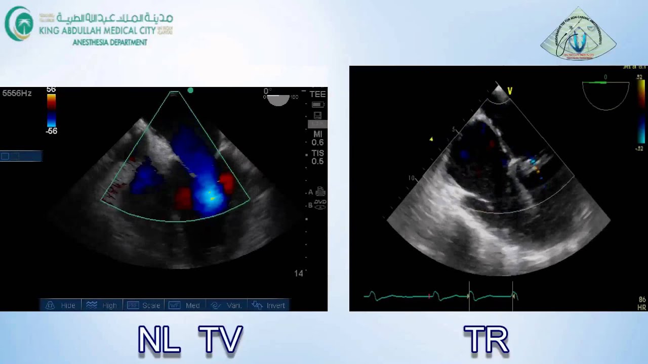 003 Tricuspid Valve Regurge TEE KAMC
