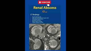 Renal Abscess - Ct - Radiology
