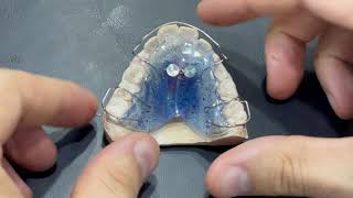 V- Shape Removable Expander, Activating Hawley Expander, Maxillary Expansion