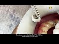 Zirconia crown removal with LiteTouchTM Er:YAG laser
