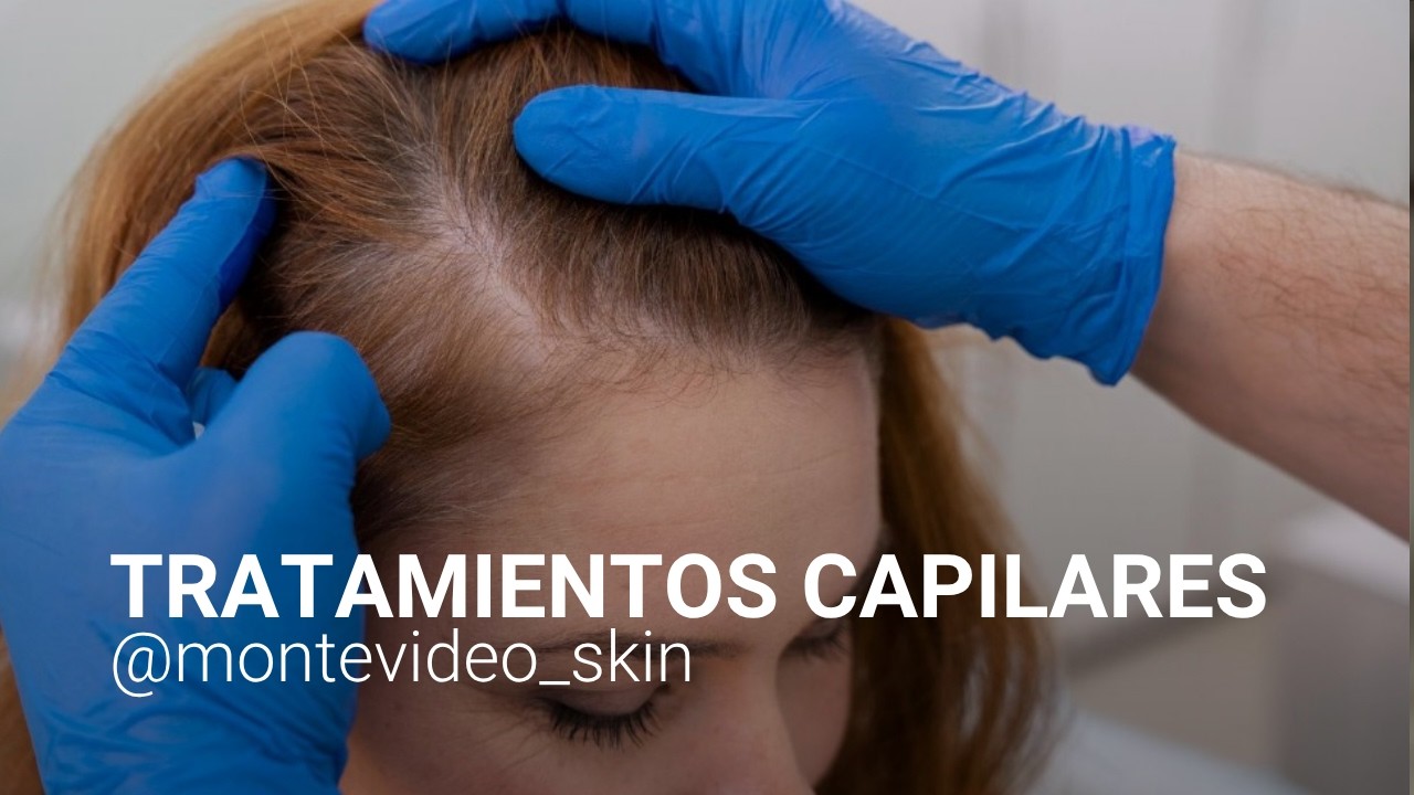 TRATAMIENTOS CAPILARES - Montevideo Skin - Cyntia de los Santos - BUENVIVIR💚 27/07/26 Canal 4