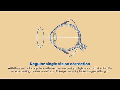 Miyosmart DIMS Myopia Control Lens.