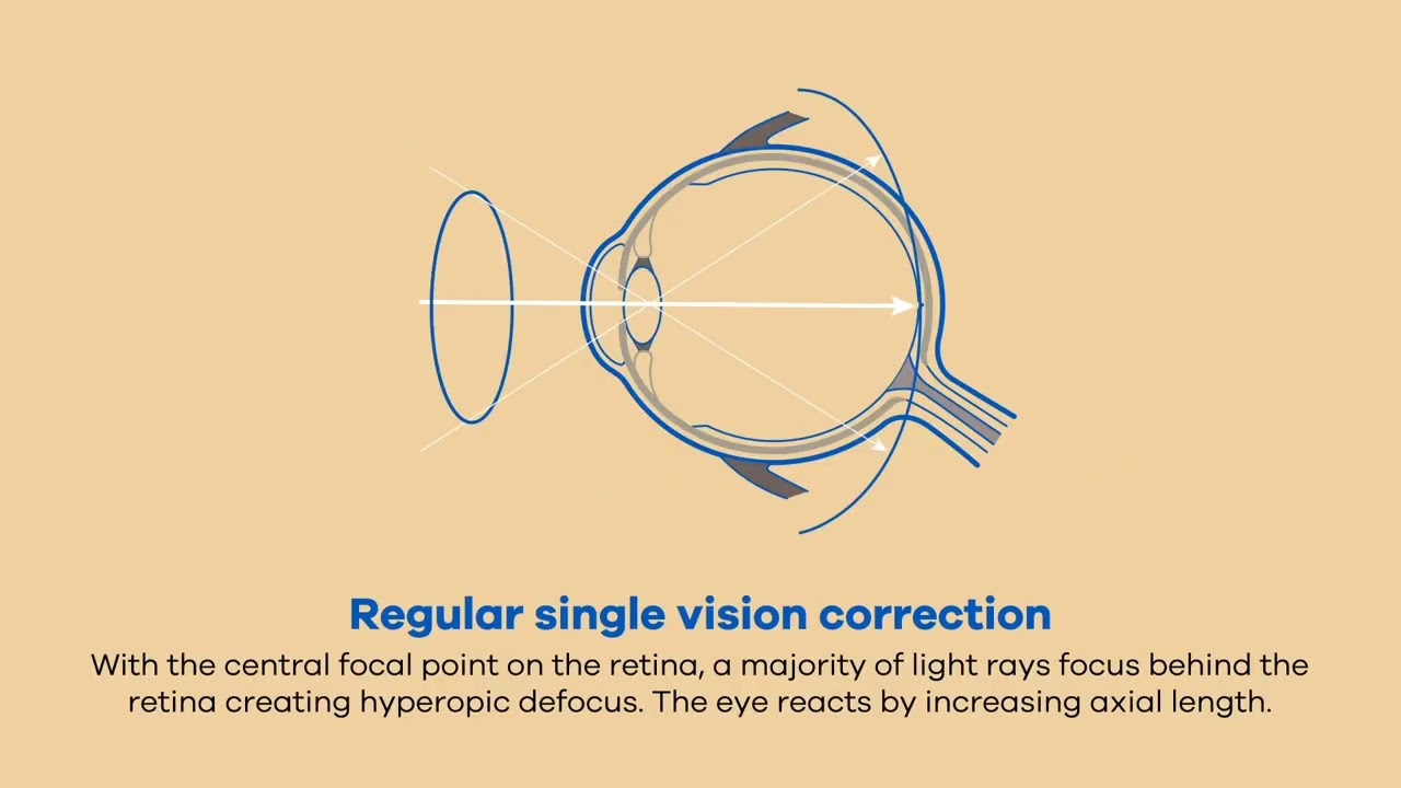 Miyosmart DIMS Myopia Control Lens.