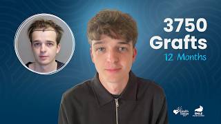 3750 Grafts Hair Transplant Transformation | 3, 6 & 12 Month Results Smile Hair Clinic