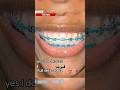Memphis Woman Goes Viral For Doing "Basement Braces" 😬
