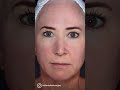 Cutera ExcelV Laser Treatment