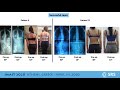 ApiFix Treatment for Scoliosis (AIS):Non-fusion technique combined with Scoliosis Specific Exercises