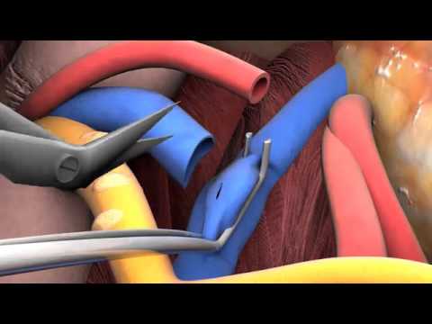 Lecture 2-6: Kidney transplant surgery