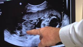 Information Gestational Diabetes | Pregnancy Care | Marian Regional Medical Center | HealthBreak Guide