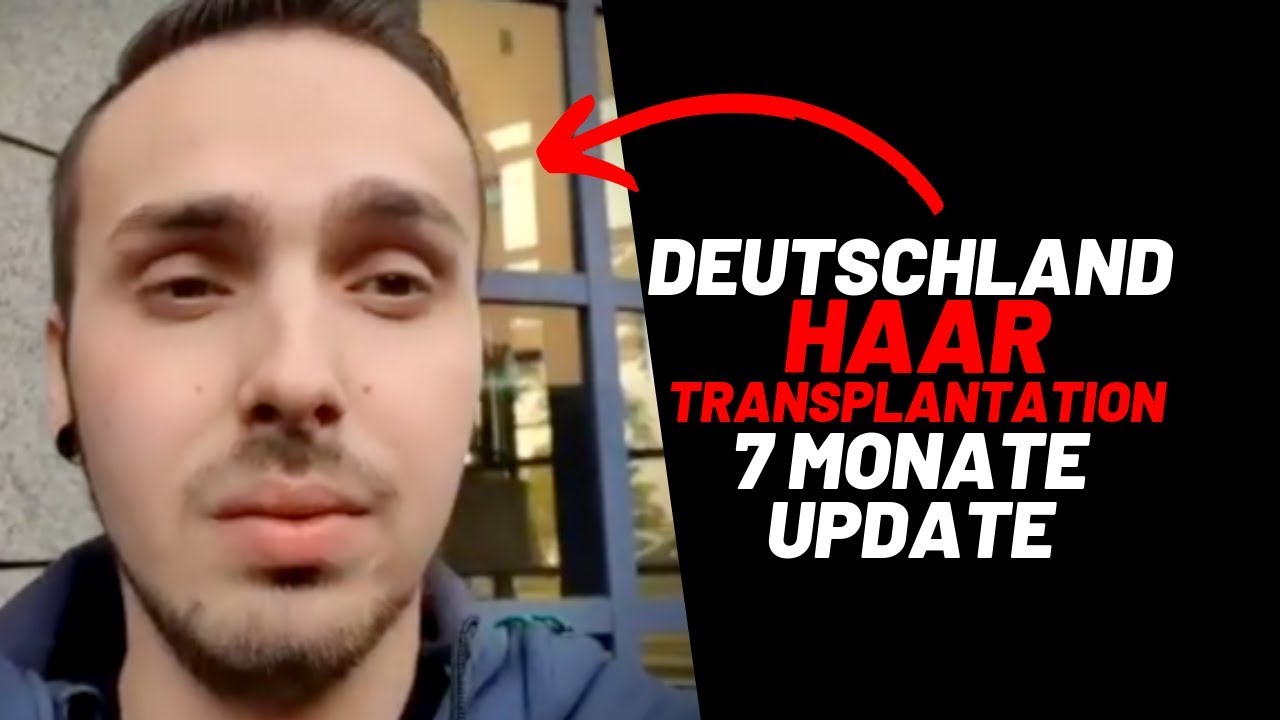Haartransplantation Deutschland Frankfurt 7 Monate sp 228 ter YouTube