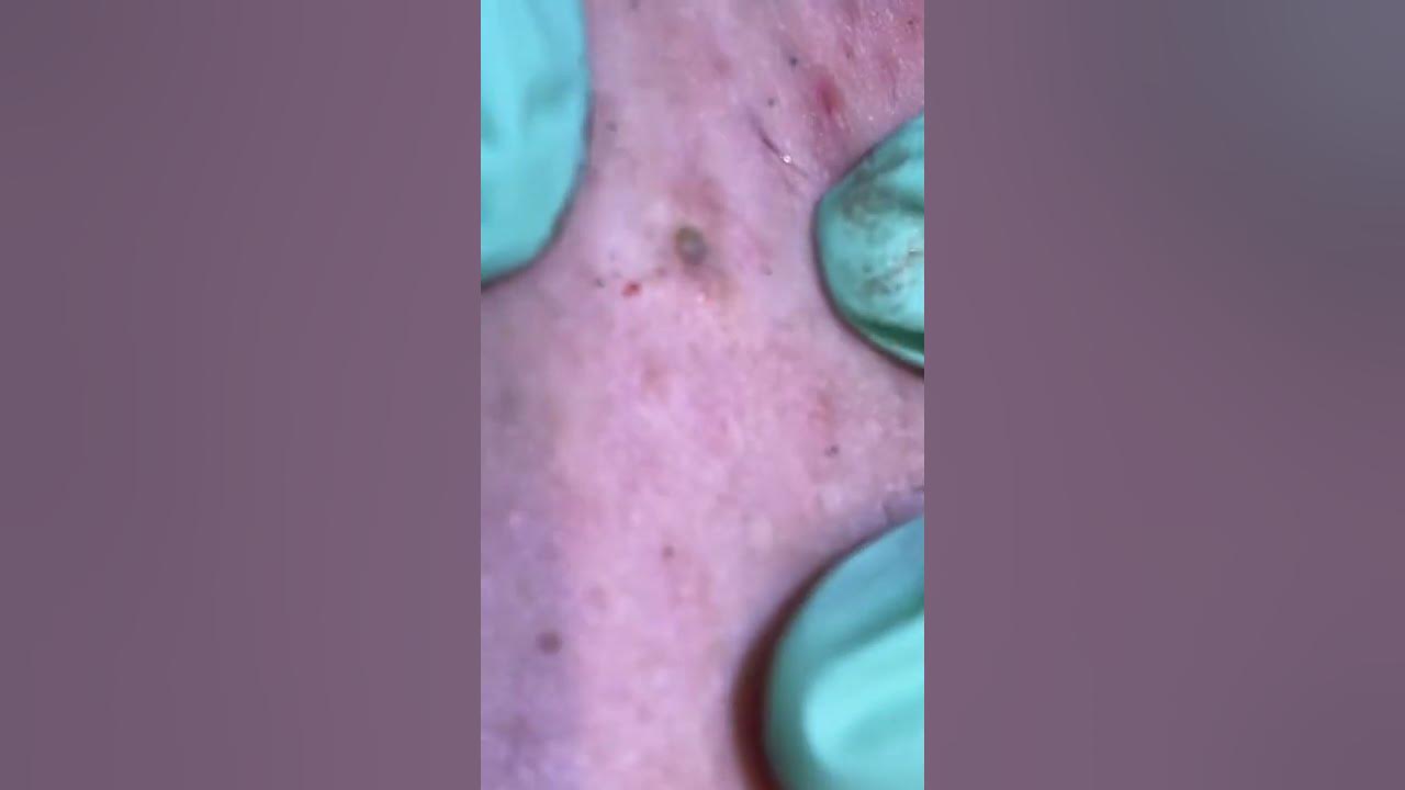 The Worst Gigantic Blackheads 2022 & Comedo Extraction YouTube