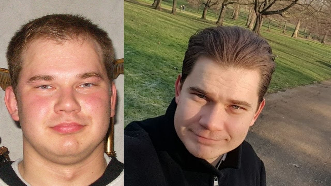 Male pattern baldness | Causes | Effects | Treatment 2020