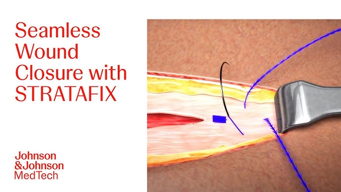 STRATAFIX Symmetric PDS Plus Alternate Initiation Suturing Technique