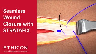 StepbyStep Guide to Wound Closure using STRATAFIX in Open Surgery | Ethicon