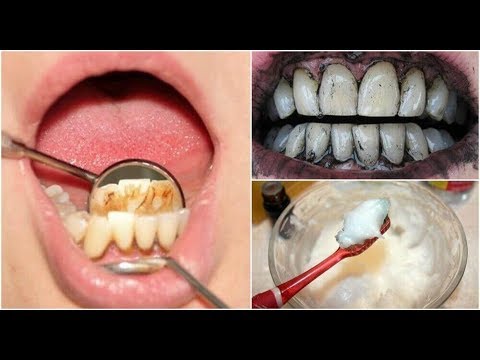 tandsteen doeltreffend verwijderen met 3 huismiddelen - youtube