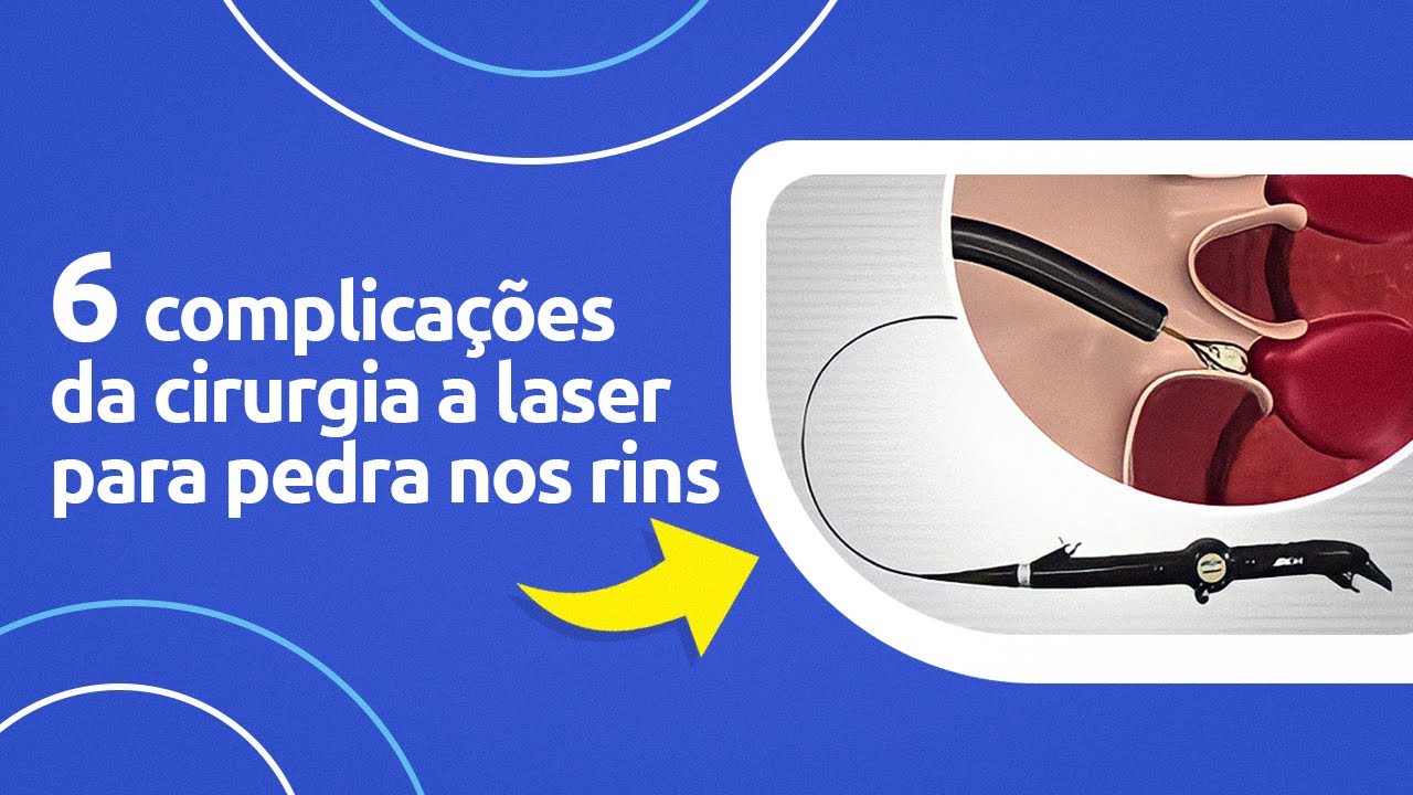6 complicações da cirurgia a laser para pedra nos rins - YouTube