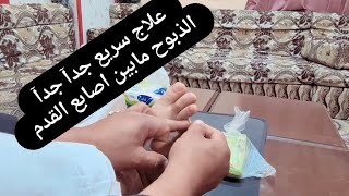 علاج فطريات مابين اصابع القدم الذبوح